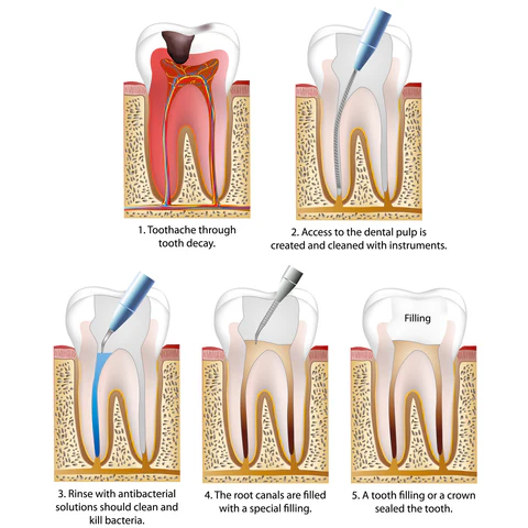 Wortelkanaalbehandeling(endodontie)