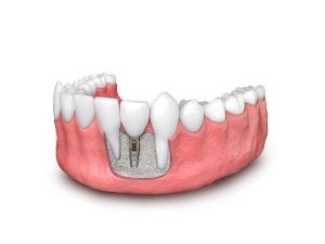 Botopbouw en implantaten tegelijk