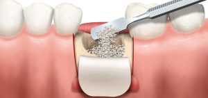Botopbouw implantaten