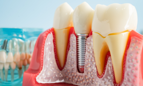 Voordelen van implantaten